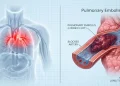 پلمونری ایمبولزم کیا ہے؟ خون جمنے سے پیدا ہونے والی خطرناک اور جان لیوا بیماری